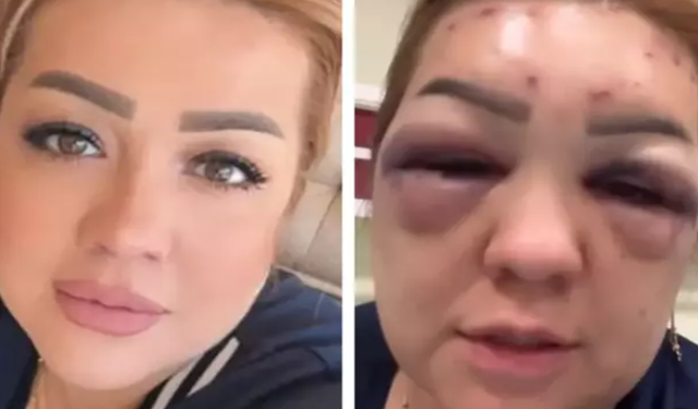 Güzelleşmek için gittiği estetik merkezinde kabusu yaşadı